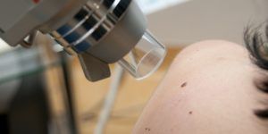 20160613_Dermatologia revision lunares_2