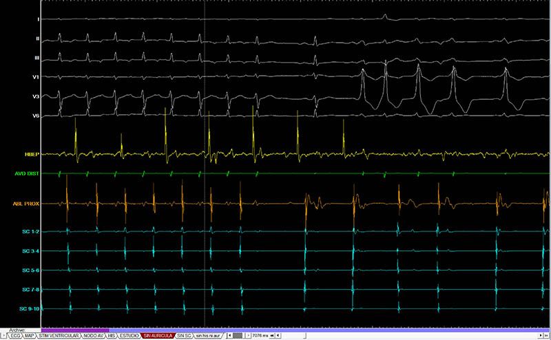 La UCLM participa en el desarrollo de un software que mejoraría el tratamiento de las arritmias