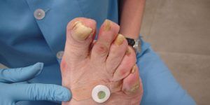 El Colegio de Podólogos de Castilla-La Mancha advierte de los riesgos de la compra en supermercados y por internet de callicidas y otros productos para los pies