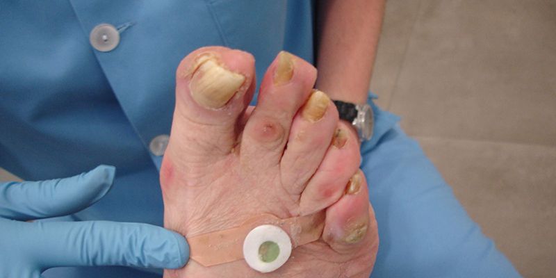 El Colegio de Podólogos de Castilla-La Mancha advierte de los riesgos de la compra en supermercados y por internet de callicidas y otros productos para los pies