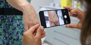 Más de 62.000 pacientes se han beneficiado de las ventajas que ofrece el programa de teledermatología implantado en toda la región hace un año