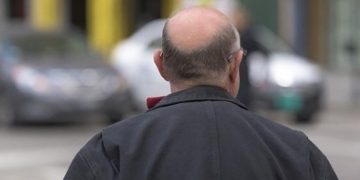 ¿Cuál es el mejor tratamiento para evitar la caída del cabello en los hombres