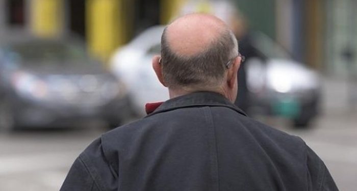 ¿Cuál es el mejor tratamiento para evitar la caída del cabello en los hombres