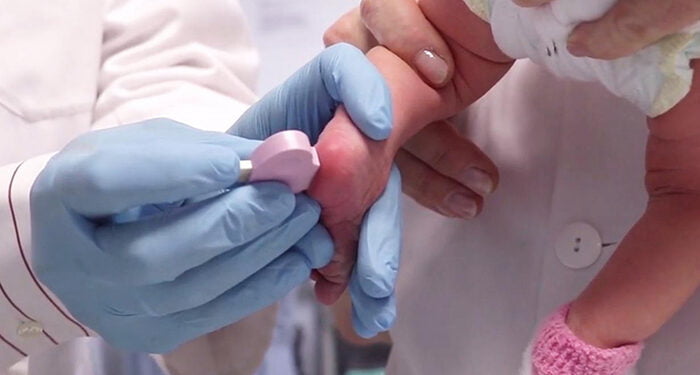 La Junta amplía a 25 las enfermedades objeto de cribado mediante la prueba del talón