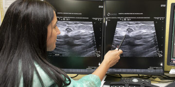 El Hospital de Guadalajara introduce la termoablación con microondas para tratar tumores de mama en mujeres que no pueden ser operadas